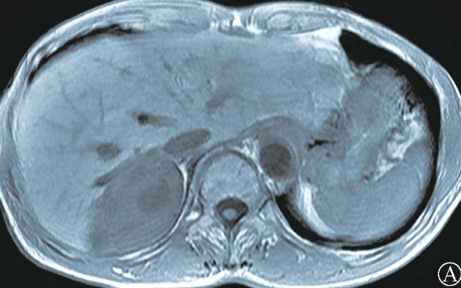 肝海绵状血管瘤